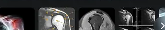 Shoulder X-ray and MRI results